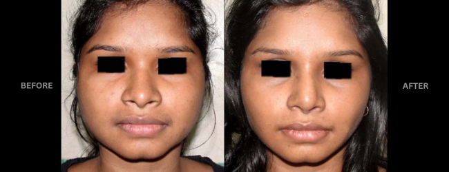 Before and After Buccal Fat Removal showing slim face after surgery