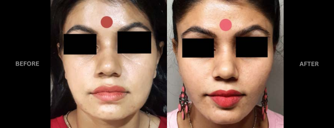 Before and after Cheek Liposuction showin sharp cheeks.