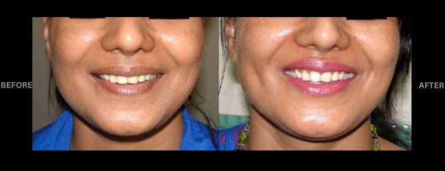 Before and after Dimple Creation Surgery showing beautiful smile.