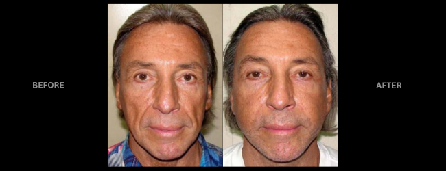 Before and after face lift surgery showing younger appearance.