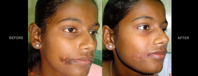 Before and After Scar revision of cheek face.