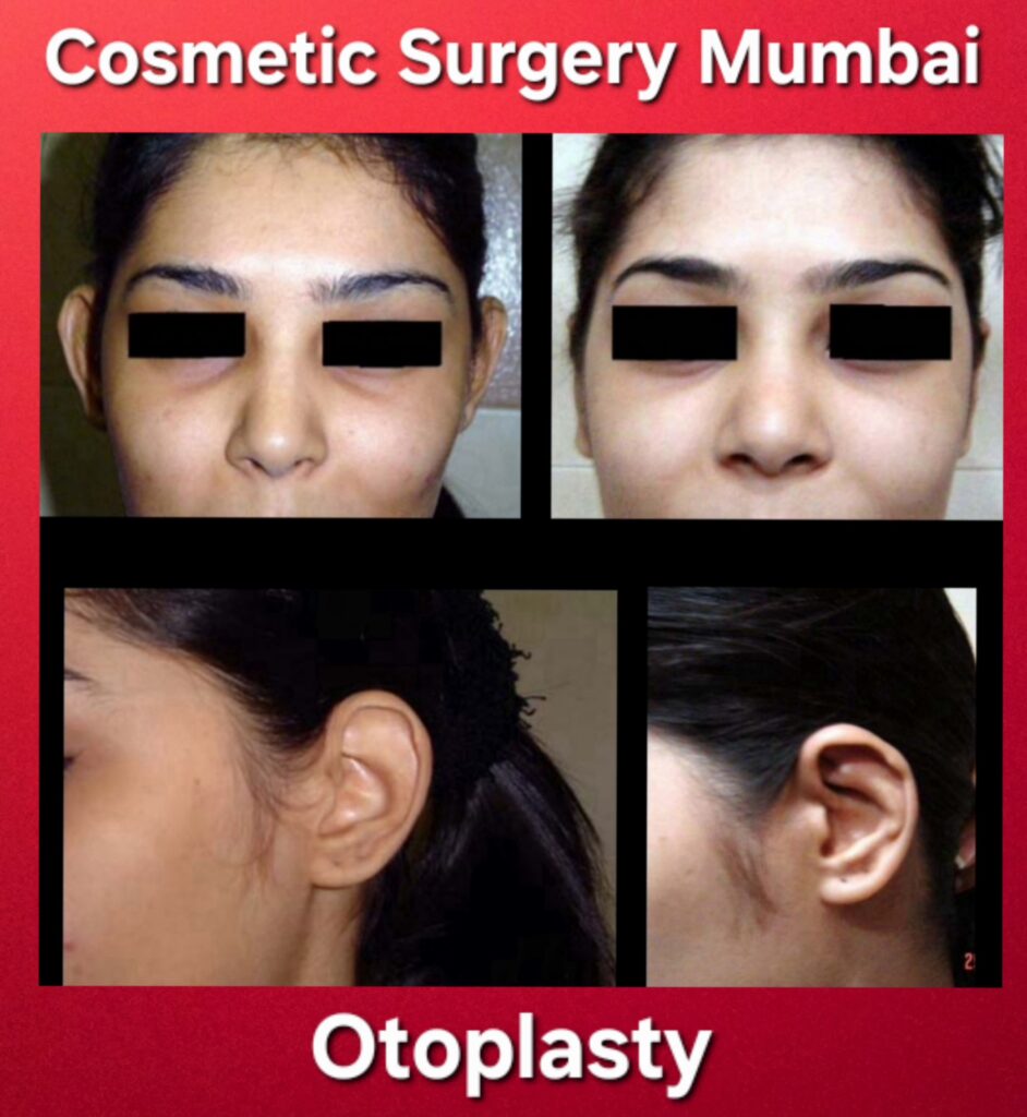 Otoplasty - Cosmetic Surgery Mumbai Ear Correction Surgery in Mumbai