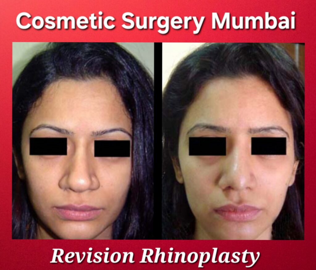 Rhinoplasty - Cosmetic Surgery Mumbai