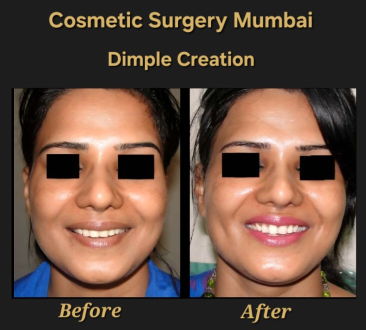 Dimple Creation