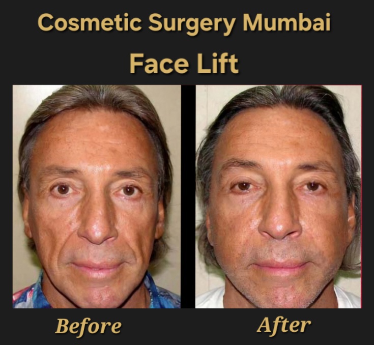 Face Lift
