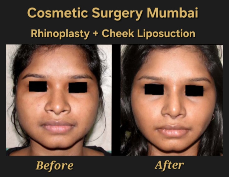 Rhinoplasty and Cheek Liposuction
