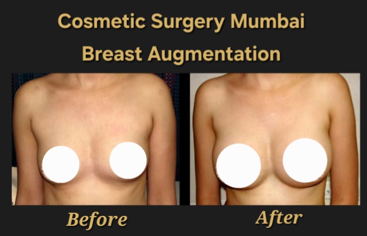 Breast Augmentation