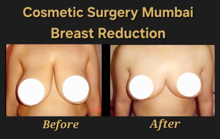 Breast Reduction