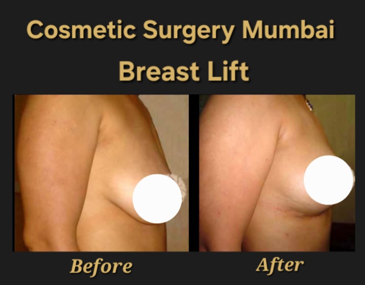 Breast Lift Surgery