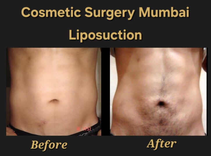 Liposuction in Mumbai