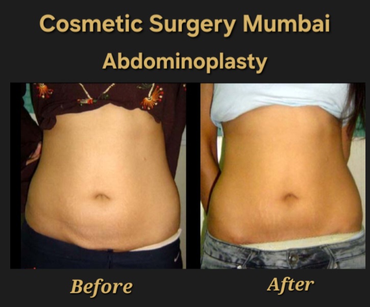 Abdominoplasty