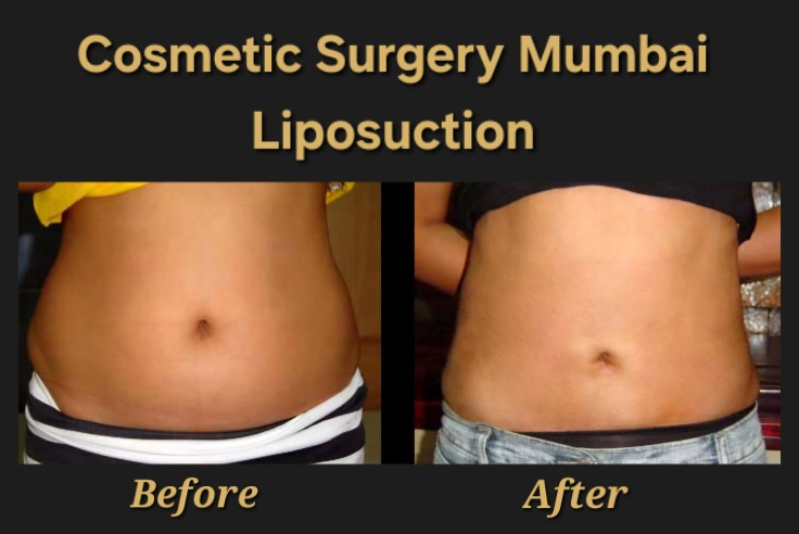 Liposuction Mumbai