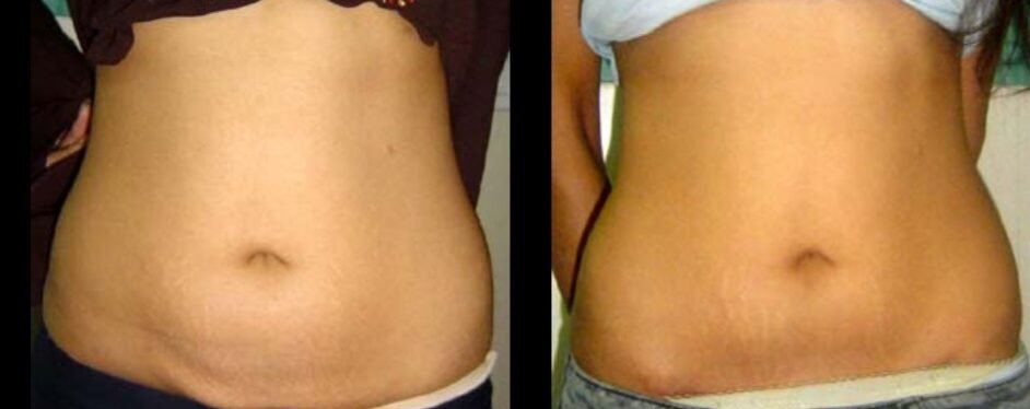 Abdominoplasty