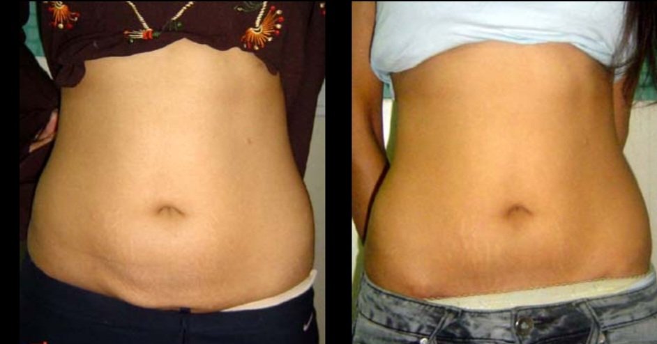 Abdominoplasty