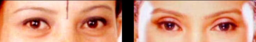 Blepharoplasty