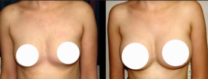 Breast Augmentation