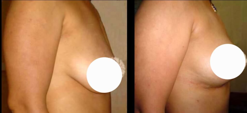 Breast Lift