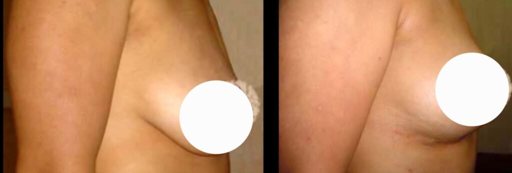 Breast Lift