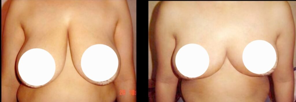 Breast Reduction