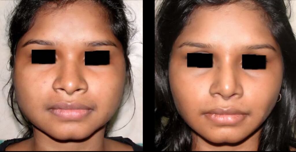 Cheek Liposuction