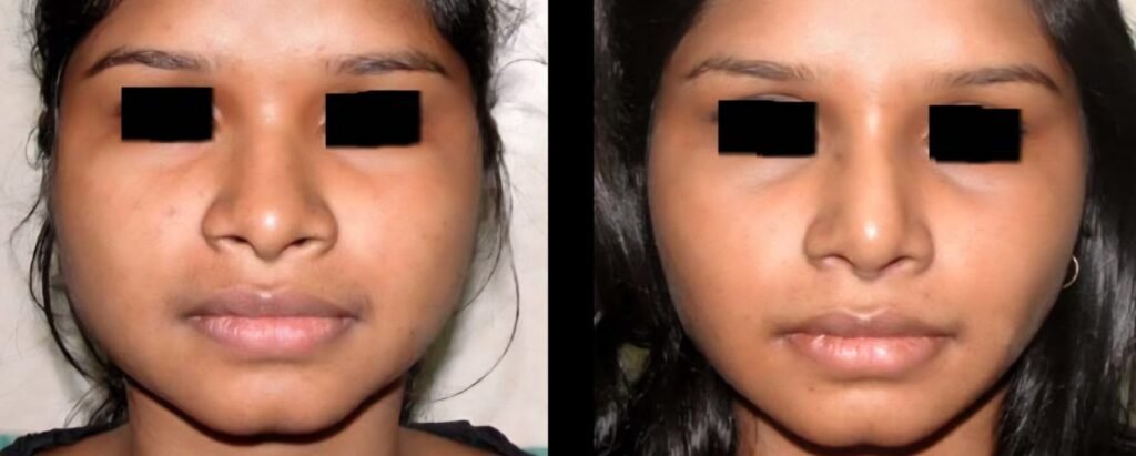 Cheek Liposuction