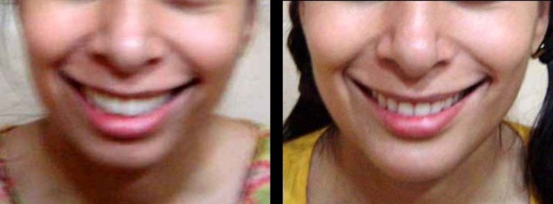 Chin Augmentation