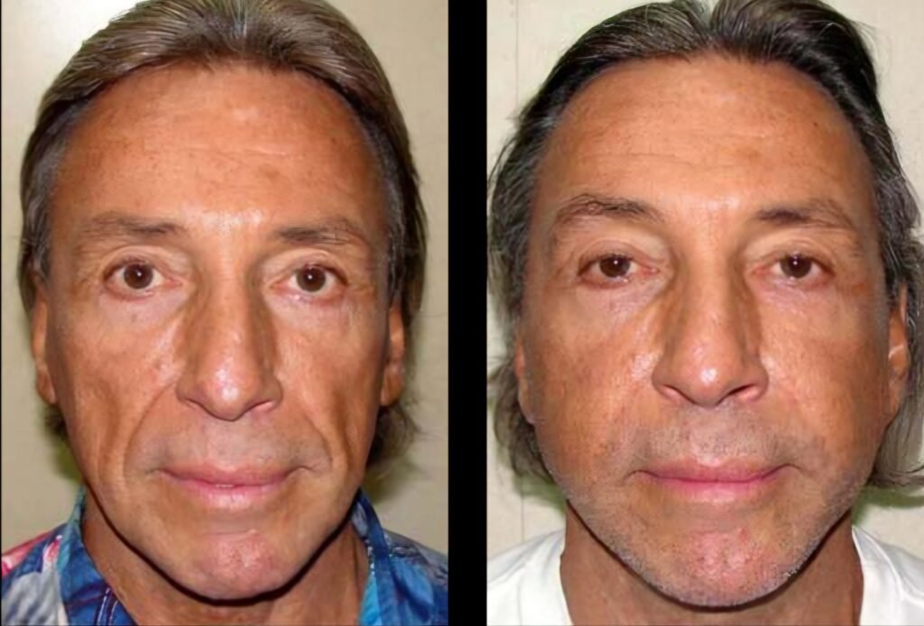 Face Lift