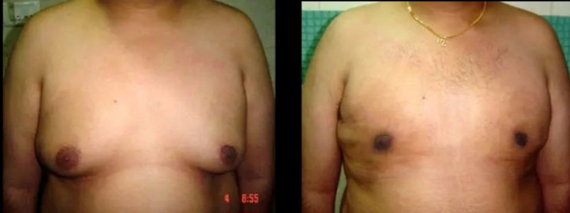Gynecomastia Correction