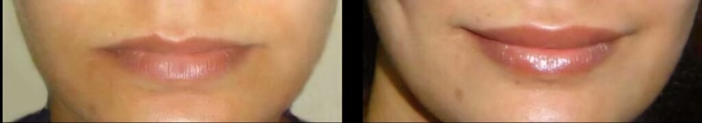 Lip Augmentation