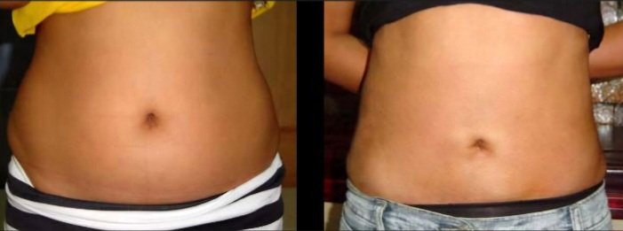 Liposuction