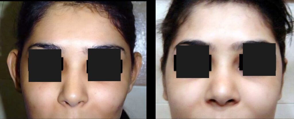 Otoplasty