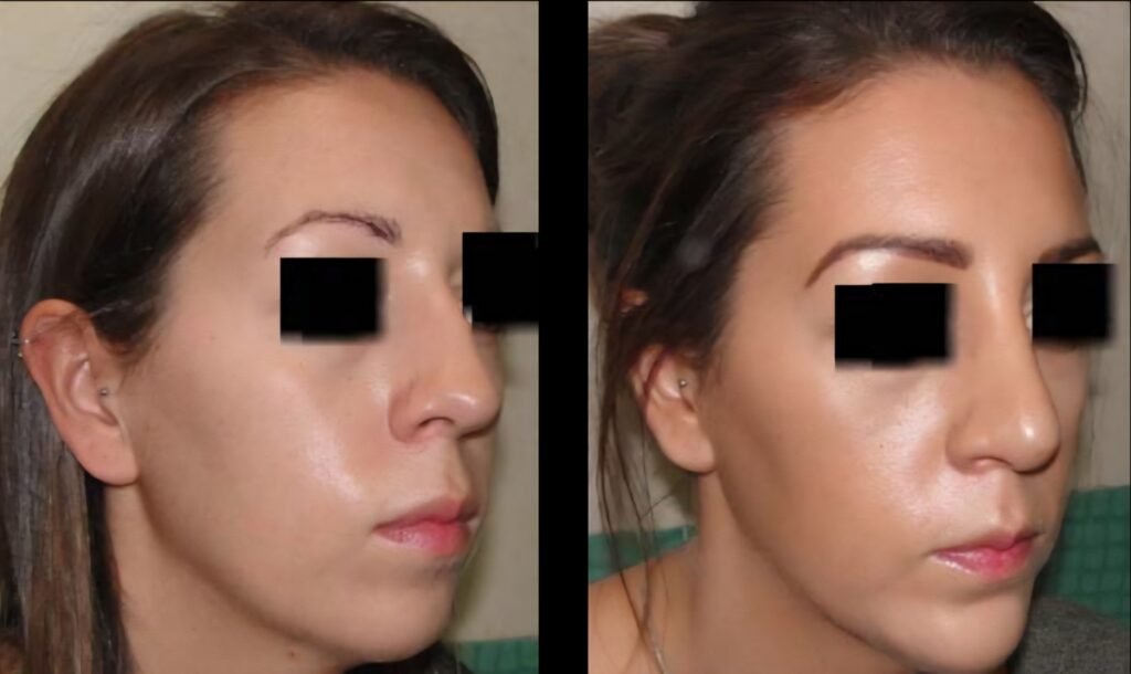 Rhinoplasty