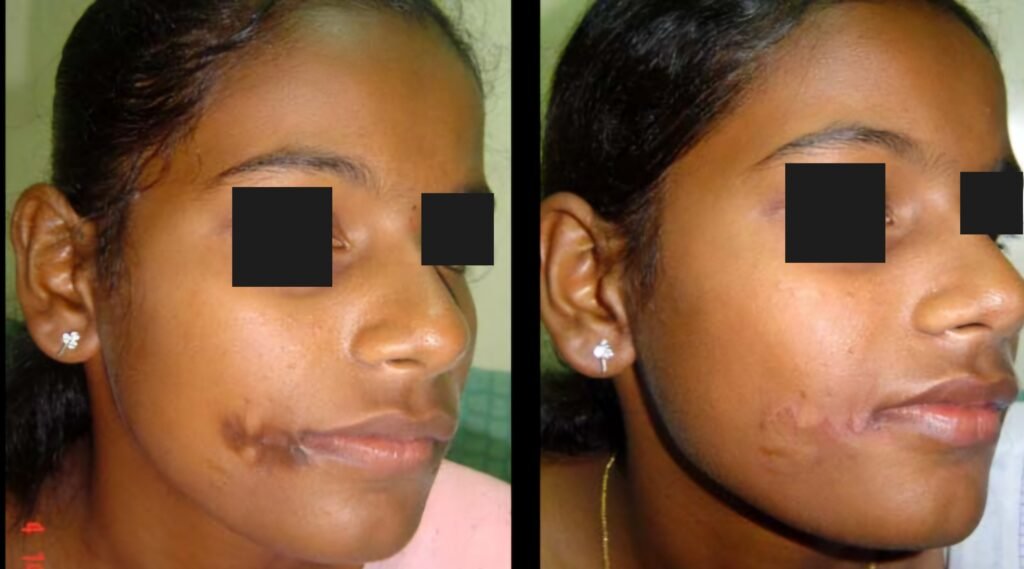 Scar Revision